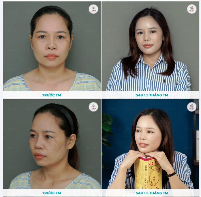 MỀM MẠI, NỮ TÍNH HÓA ĐƯỜNG NÉT KHUÔN MẶT NHỜ CẤY MỠ, CẮT MÍ, NÂNG MŨI TINY POINT