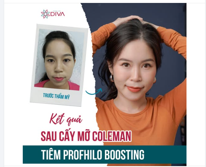 RẠNG NGỜI, TRẺ TRUNG SAU KHI CẤY MỠ + TIÊM PROFHILO