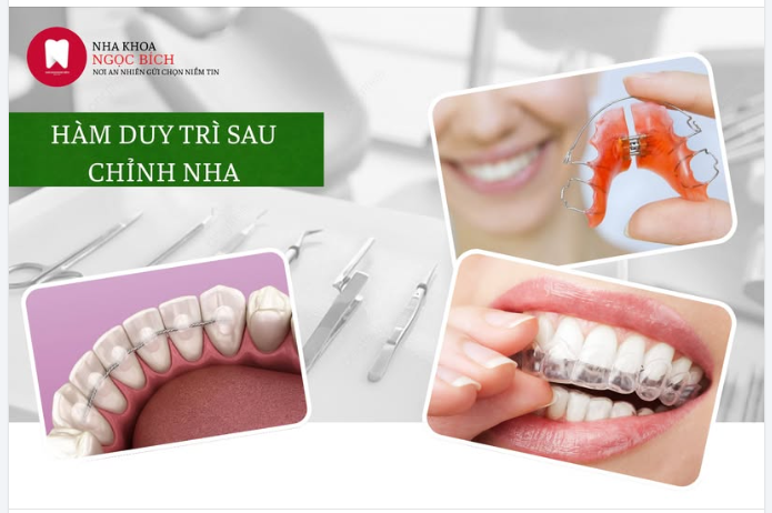 Đeo Hàm Duy Trì Sau Chỉnh Nha – Bước Quan Trọng Quyết Định KẾT QUẢ NIỀNG RĂNG
