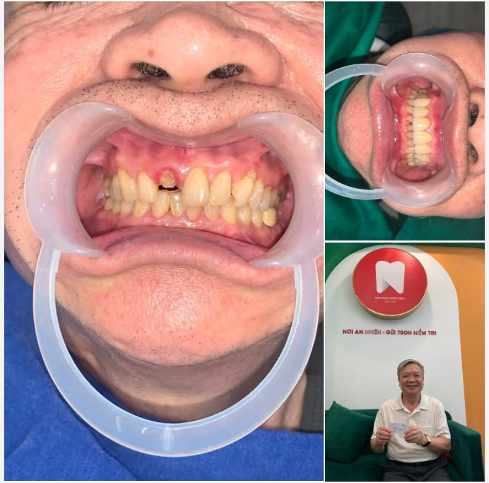 Khôi Phục Nụ Cười Tự Tin Với Cầu Răng Mất Răng Cửa - Nha Khoa Ngọc Bích