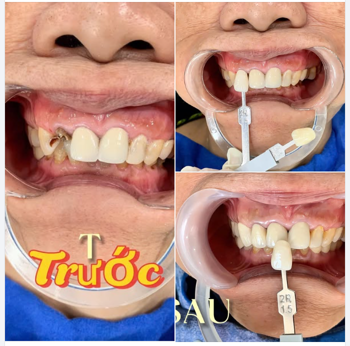 MẤT RĂNG THÌ PHẢI LÀM SAO ?