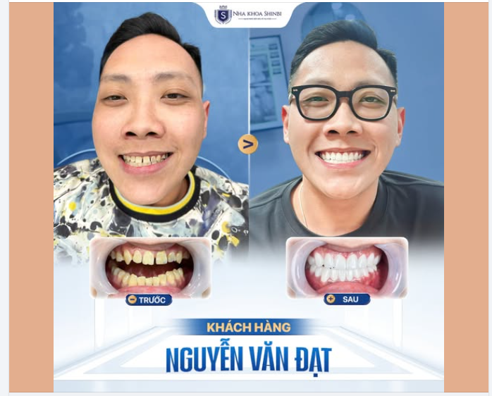 Trước – Sau bọc răng sứ HT Smile Nguyễn Văn Đạt (29 tuổi)