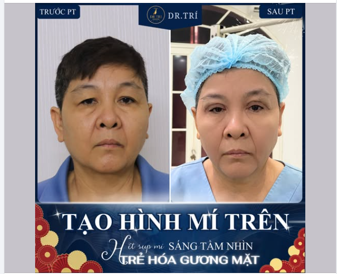 SỢ MẮT SỤP – NGẠI DAO KÉO? LẤY LẠI 10 NĂM THANH XUÂN CHỈ SAU 45 PHÚT!