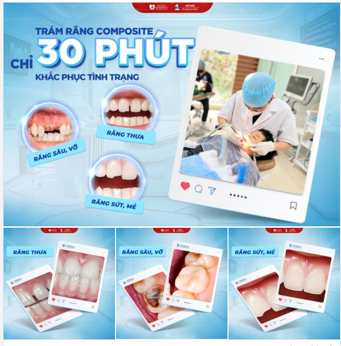 TRÁM RĂNG COMPOSITE CHỈ 30 PHÚT - TẠM BIỆT MỌI KHUYẾT ĐIỂM!