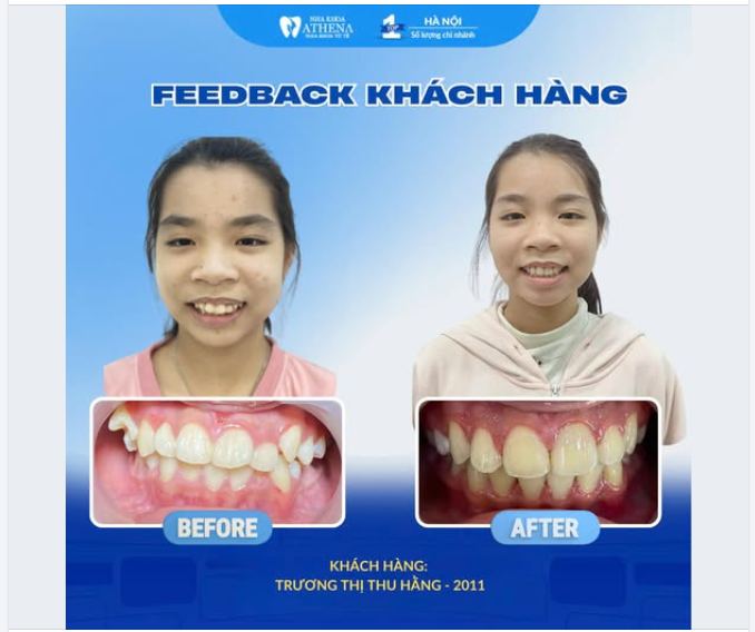 FEEDBACK KHÁCH HÀNG TẠI NHA KHOA ATHENA