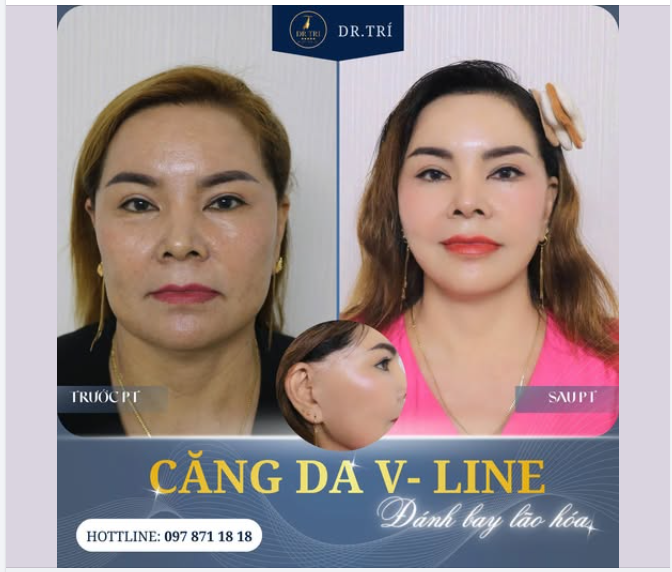 Từ tình trạng da chùng nhão, kém săn chắc → làn da căng mịn, đường nét gương mặt gọn gàng và trẻ trung hơn.
