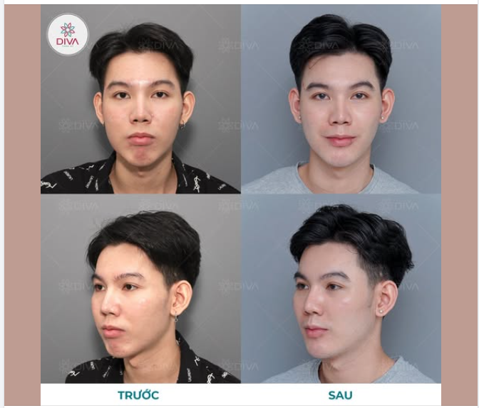 MẶT CHẢY XỆ, MÁ PHÍNH DO TÚI MỠ MÁ, CẰM LẸM THIẾU ĐỘ NHÔ VÀ KẾT QUẢ SAU THẨM MỸ?
