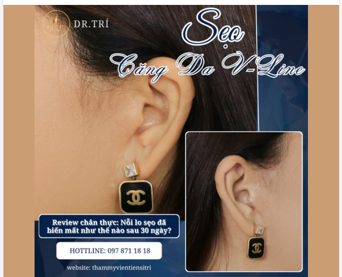 REVIEW CHÂN THỰC: KẾT QUẢ CĂNG DA V-LINE SAU 30 NGÀY TẠI DR. TRÍ