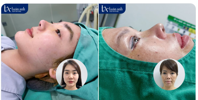 Muốn rạng rỡ đón Tết mà không phải chờ đợi lâu, chị em đừng bỏ lỡ dáng mũi cao thanh tú này.