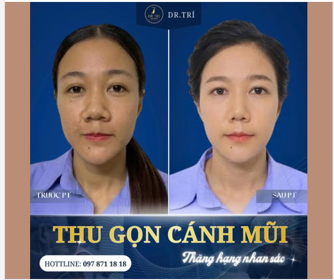 THU GỌN CÁNH MŨI – THAY ĐỔI NHỎ, KHÁC BIỆT LỚN