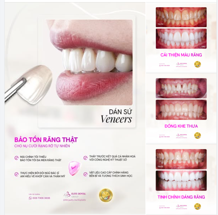 LÀM ĐẸP NỤ CƯỜI KHÔNG ĐỒNG NGHĨA VỚI VIỆC "ĐÁNH ĐỔI" RĂNG THẬT!