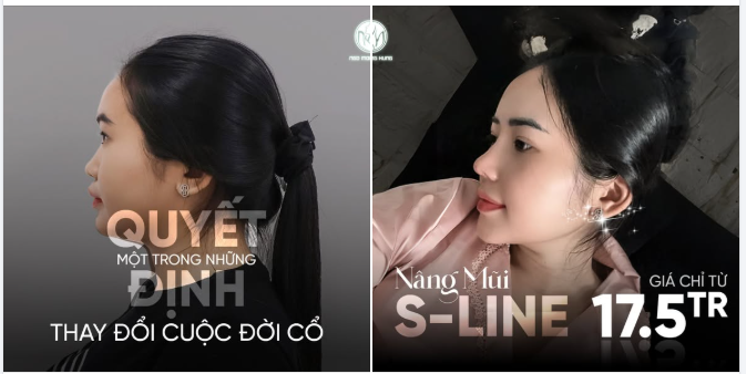 Một trong những quyết định thay đổi cuộc đời cổ: NÂNG MŨI