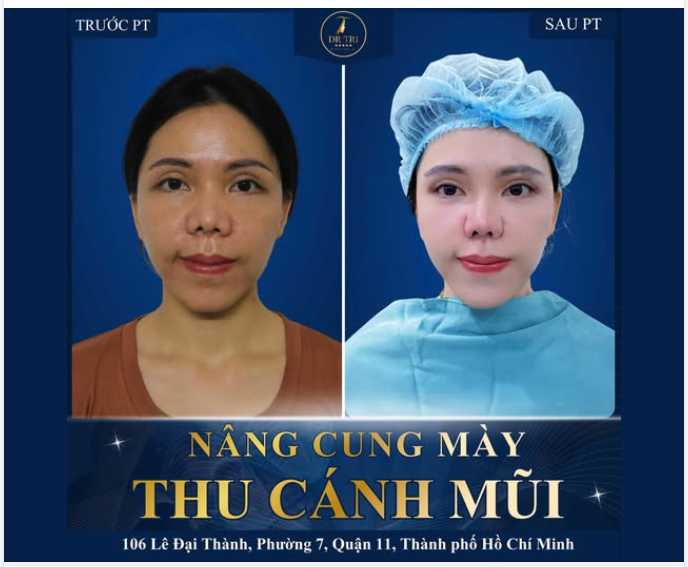 ĐỪNG ĐỂ ĐÔI MẮT BUỒN VÀ CHIẾC MŨI RỘNG LÀM BẠN THIẾU TỰ TIN!