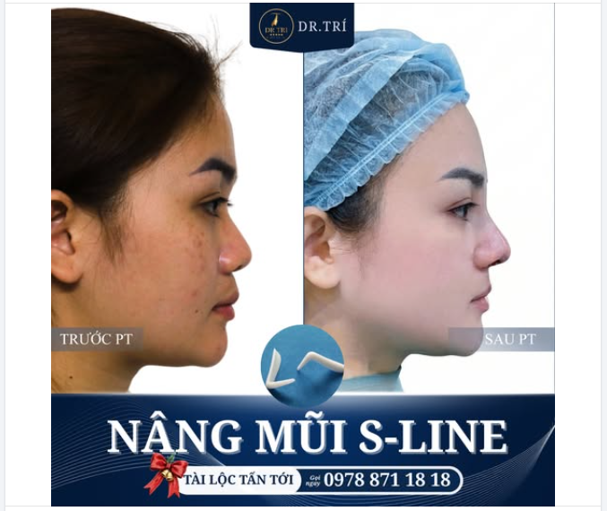 MŨI CAO THANH TÚ – TÀI LỘC ĐẦY TAY