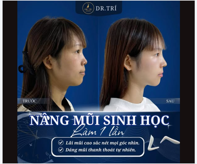 TỰ TIN GÓC NGHIÊM VỚI NÂNG MŨI SINH HỌC