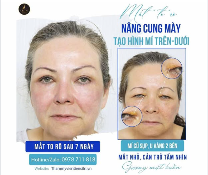 Bài Viết Dành Cho Các Anh Chị Bị Lão Hóa Mắt, Sụp Mí, Mí Không Đều