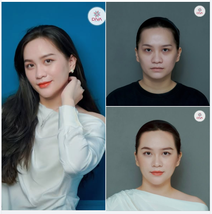 GƯƠNG MẶT HÓA TƯƠI TẮN NHỜ CẢI THIỆN QUẦNG THÂM MẮT VÀ CÁC VÙNG TRŨNG KHUYẾT VỚI PP CẤY MỠ!