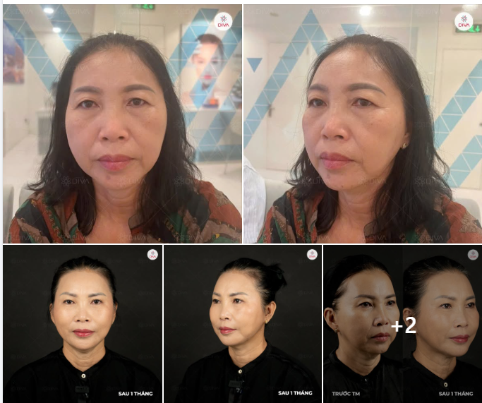GIẢM CHẢY XỆ, RÃNH CƯỜI SÂU - THẦN THÁI TƯƠI TẮN, TRẺ TRUNG HƠN SAU KHI FILLER MD CODES!