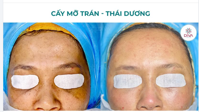VÙNG TRÁN VÀ THÁI DƯƠNG BỊ HÓP THÌ PHƯƠNG PHÁP NÀO CÓ THỂ CẢI THIỆN HIỆU QUẢ?