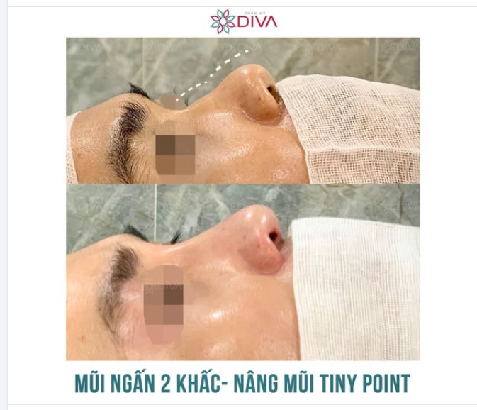 MŨI GẬP GHỀNH - CẢI THIỆN NHANH CHÓNG NHỜ NÂNG MŨI TINY POINT