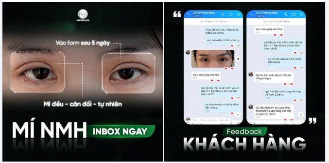"Lúc đầu làm em sợ sưng lắm, mà trộm vía làm xong em thấy cũng không bị nhiều"- KH Feedback sau 5 ngày làm mí tại BV PTTM Ngô Mộng Hùng