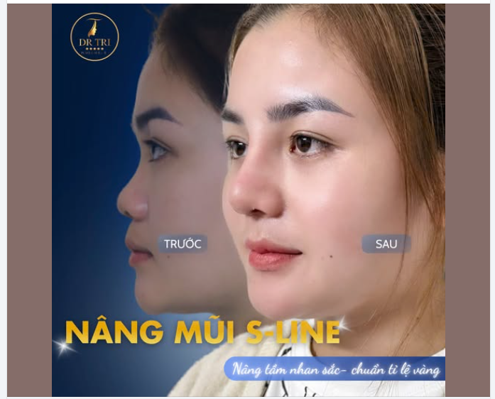 TẠM BIỆT CHIẾC MŨI THẤP, CHÀO ĐÓN DIỆN MẠO RẠNG RỠ TẠI DR. TRÍ