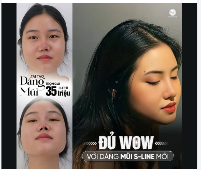 1 nhan sắc thăn hạng sau khi tái tạo dáng mũi!