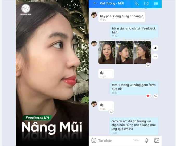 NHẢ VÍA NHẸ DÁNG MŨI SAU 2 TUẦN