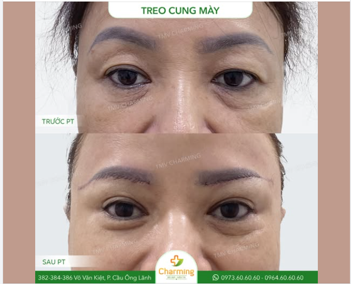 Sở hữu đôi mắt tinh anh và cung mày thanh tú là mong muốn của bất kỳ ai khi bước vào độ tuổi lão hóa.