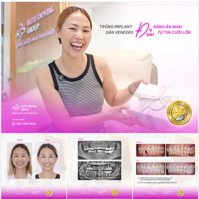 3 TUẦN VỀ VIỆT NAM GIẢI QUYẾT DỨT ĐIỂM TÌNH TRẠNG MẤT NHIỀU RĂNG