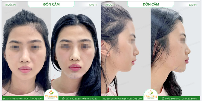 GÓC NGHIÊNG "HẠT DẺ" - CẰM LẸP HOÁ V-LINE