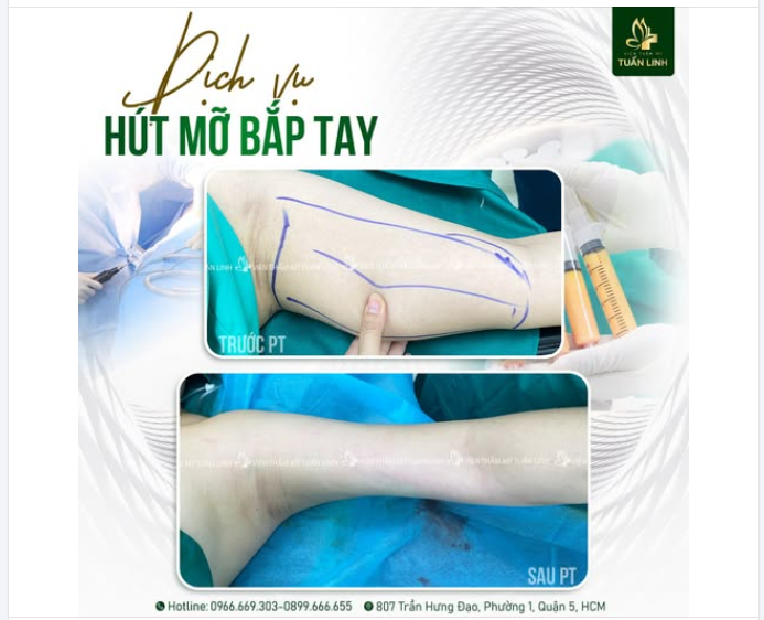 “Mình chưa từng nghĩ chỉ thay đổi bắp tay lại khiến cả cơ thể khác đi nhiều đến vậy…”