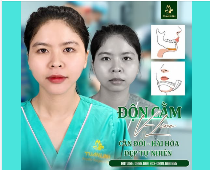ĐỘN CẰM VLINE – HOÀN THIỆN NHAN SẮC, CÂN CHỈNH PHONG THỦY