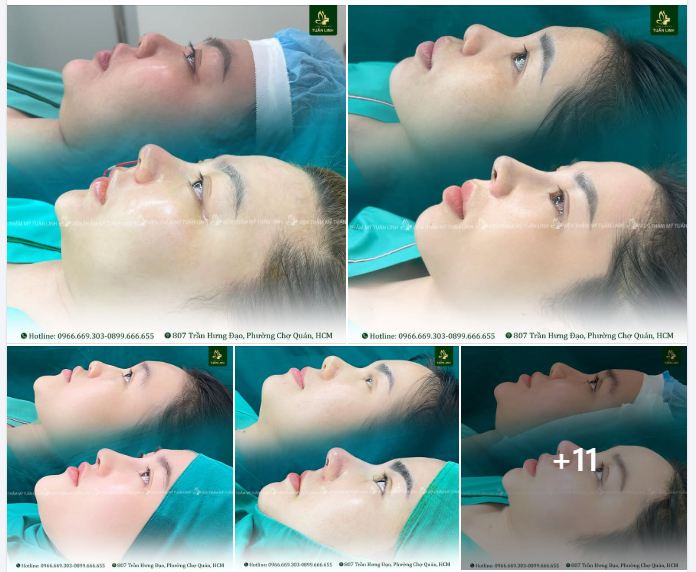 20 CASE NÂNG MŨI TRONG NGÀY - LÀM ĐẸP BÂY GIỜ CÒN CHỜ ĐẾN KHI NÀO!!!