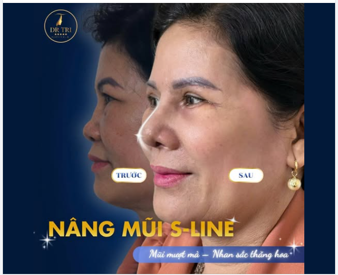 NÂNG MŨI S-LINE – ĐẸP TỰ NHIÊN MỌI GÓC NHÌN
