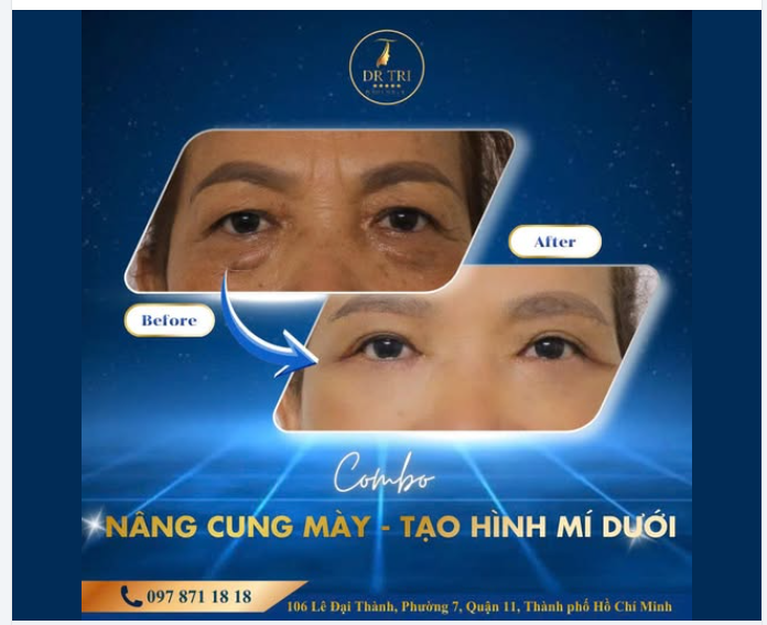 GIẢI PHÁP HOÀN HẢO CHO ĐÔI MẮT LÃO HÓA TẠI DR. TRÍ