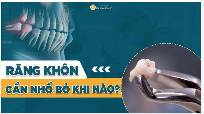 KHI NÀO RĂNG KHÔN CẦN NHỔ BỎ ĐỪNG ĐỂ ĐAU MỚI ĐI KHÁM