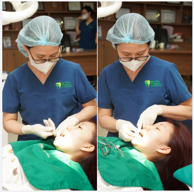 Trong quá trình niềng răng, mỗi lần tái khám đều đóng vai trò quan trọng để bác sĩ theo dõi và điều chỉnh lực di chuyển của răng một cách chính xác.
