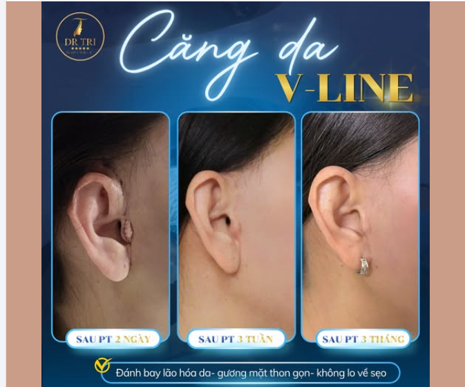KỸ THUẬT KHÂU GIẤU SẸO ĐỈNH CAO TRONG CĂNG DA V-LINE TẠI DR. TRÍ
