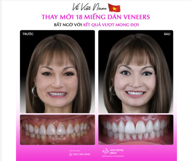 Sinh sống nhiều năm tại Mỹ, chị chưa từng nghĩ sẽ về Việt Nam làm răng. Cho đến khi nhìn thấy kết quả Veneers đẹp tự nhiên của người thân sau điều trị tại Elite Dental.