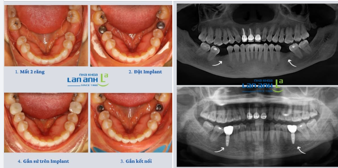 Mất răng số 6 hàm dưới? Implant vẫn là lựa chọn phục hình tối ưu.