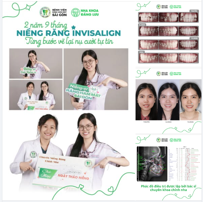 2 NĂM 9 THÁNG NIỀNG RĂNG INVISALIGN - TỪNG BƯỚC TÌM LẠI NỤ CƯỜI TỰ TIN