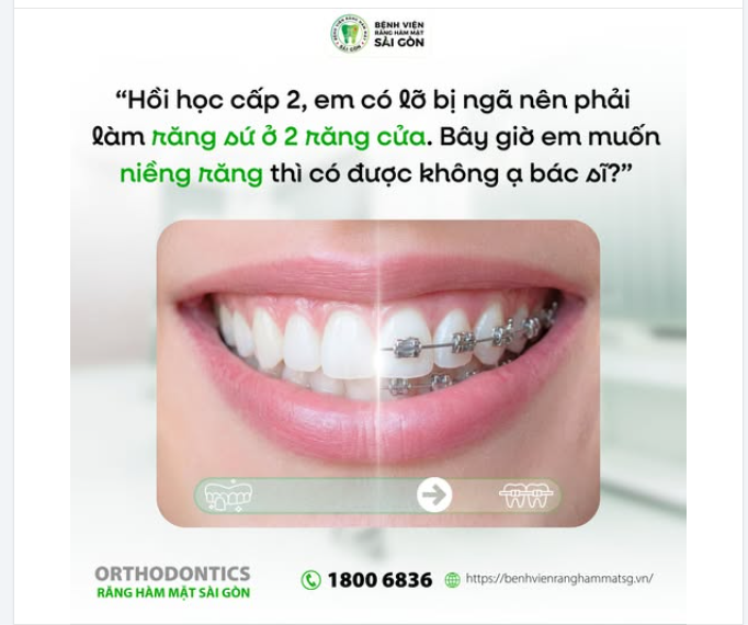 “Bác sĩ ơi, lúc học cấp 2 em từng bị 'ngã' nên đã làm răng sứ 2 răng cửa. Bây giờ em muốn niềng thì có được không ạ?”