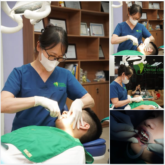 Bao nhiêu tuổi là niềng răng tốt nhất?