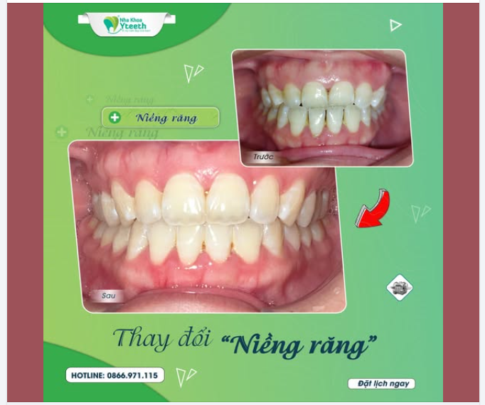 Khớp cắn ngược có nên niềng răng không?