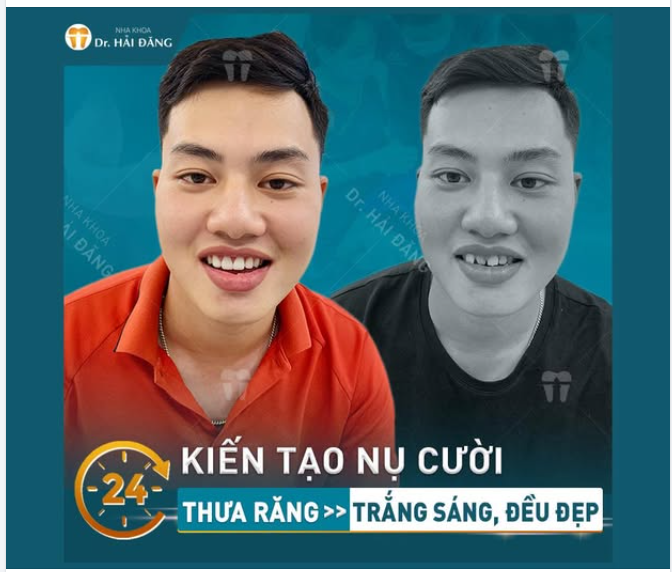 Từ tình trạng thưa răng, kém đều, khách hàng đã sở hữu hàm răng trắng sáng – đều đẹp – tự nhiên, giúp gương mặt hài hòa và nụ cười rạng rỡ hơn chỉ trong thời gian ngắn.
