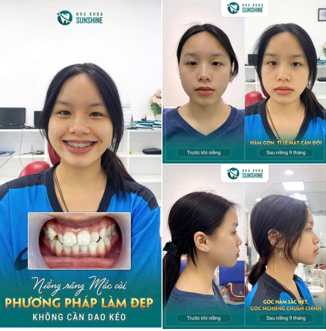 Với học sinh, sinh viên, đây cũng là giai đoạn xương hàm còn thích nghi tốt nên việc can thiệp thường thuận lợi hơn.