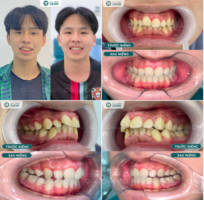 Chỉnh nha bằng mắc cài giúp đưa răng về đúng vị trí, cải thiện khớp cắn và giữ răng ổn định hơn về sau.