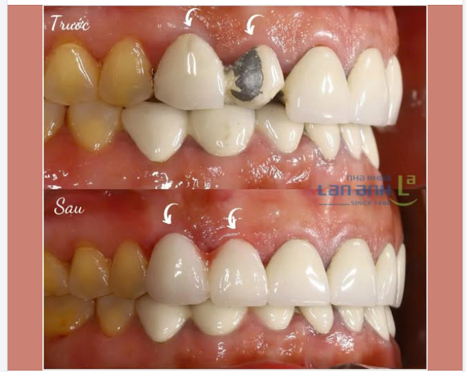 “Cứu nguy” thành công cho răng 12–13 bị bong mão cũ, lộ viền đen mất thẩm mỹ.
