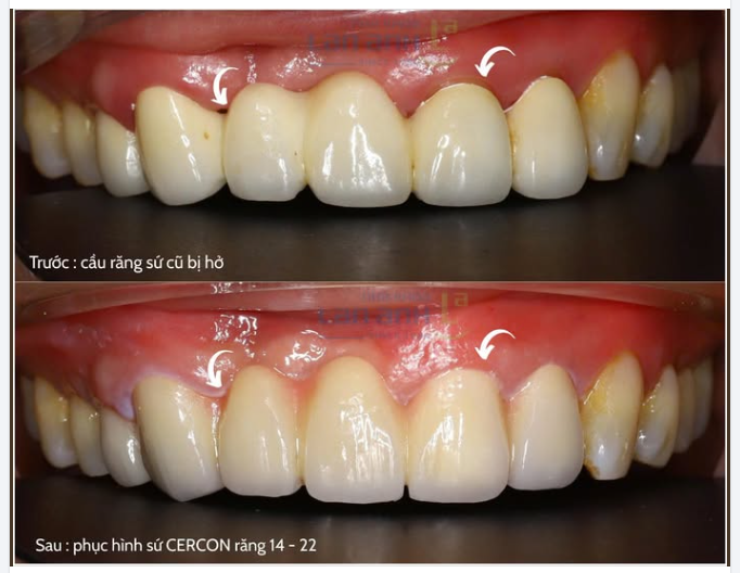 Chiếc cầu răng cũ đã “đến lúc nghỉ hưu”…  Cầu răng bị hở viền, mất thẩm mỹ